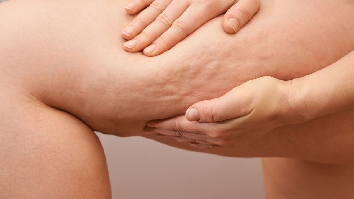 Egy kéz tapintja a comb bőrét, amelyen láthatóak az eperbőr jelei.